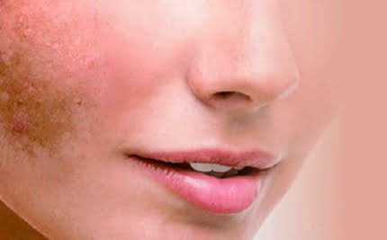 Melasma
