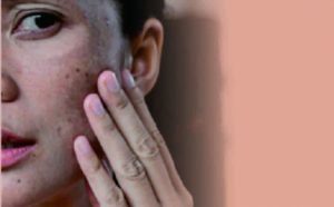 Perbedaan Melasma dan Flek Hitam Bercak Gelap di Kulit