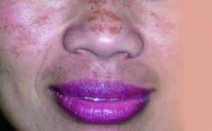 Ini Cara Perawatan Melasma dan Flek Hitam