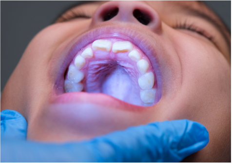 Pakai Bahan Ini untuk Hilangkan Bau Napas secara Alami